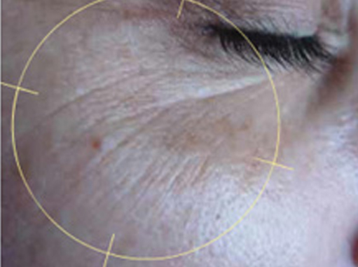 Before-Bore oko očiju