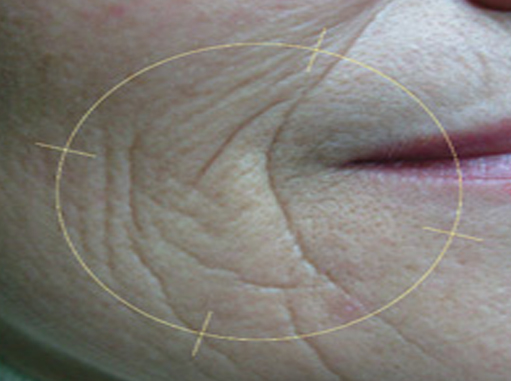 Before-Bore oko usana