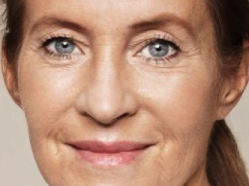 After-Ultrazvučna hidratacija