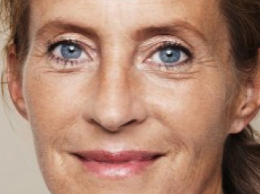 Before-Ultrazvučna hidratacija