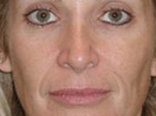 Before-Mikrodermoabrazija celog lica