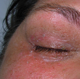 After-Virusne bradavice 