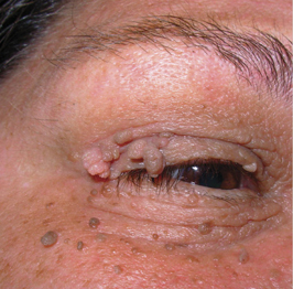 Before-Virusne bradavice 