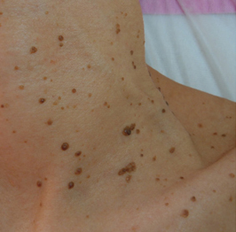 Before-Virusne bradavice