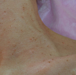 After-Virusne bradavice