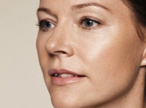 After-Ultrazvučna hidratacija