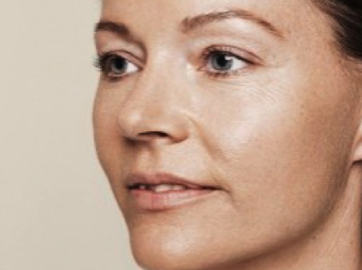 Before-Ultrazvučna hidratacija