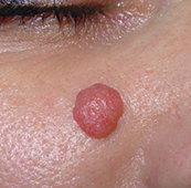 Before-Mladeži na licu